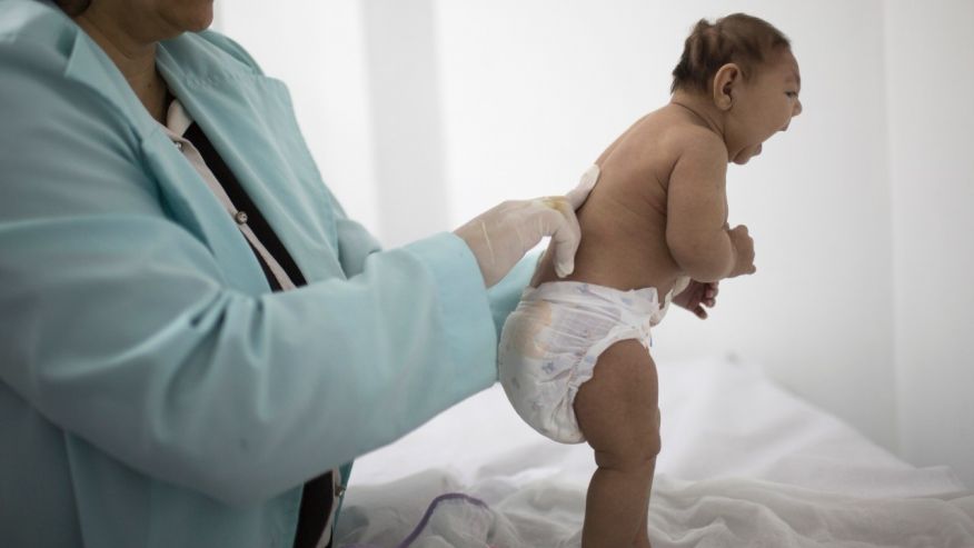 Lara who is less then 3-months old and was born with microcephaly is examined by a neurologist at the Pedro I hospital in Campina Grande Paraiba state Brazil