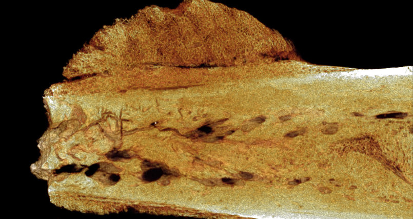 The inside of one of the bones showing the cancer