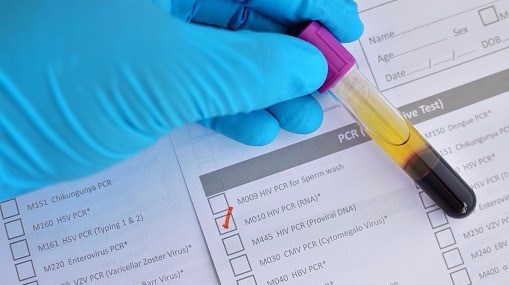 HIV test Thinkstock