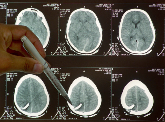 Second stroke predicted by health prior to first stroke: Study