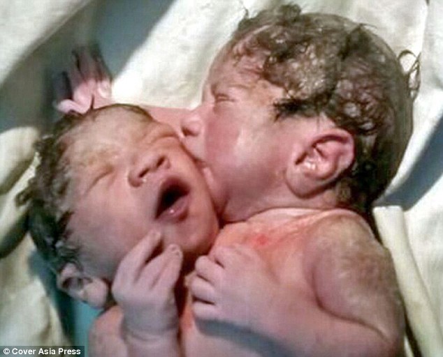 Sion woman gives birth to conjoined twins