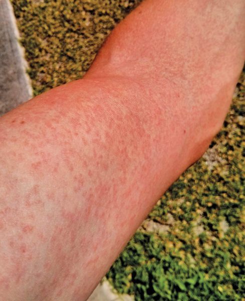 Zika virus mosquitoes: Typical rash caused by Zika Virus