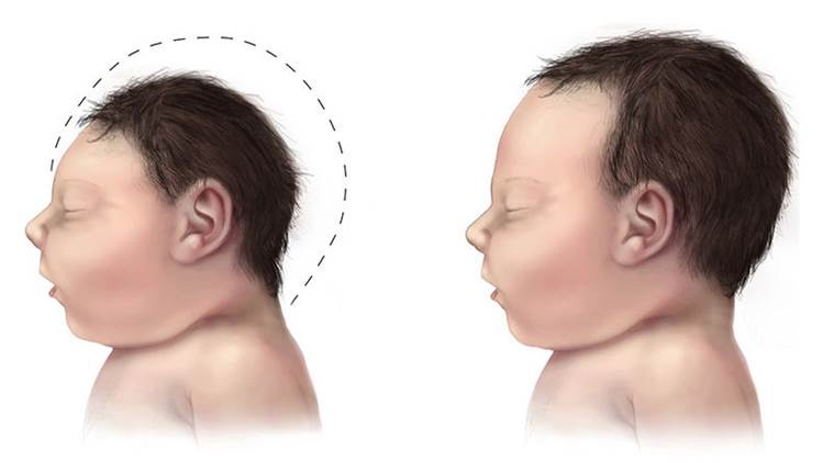 Zika virus birth deformities congenital birth defects