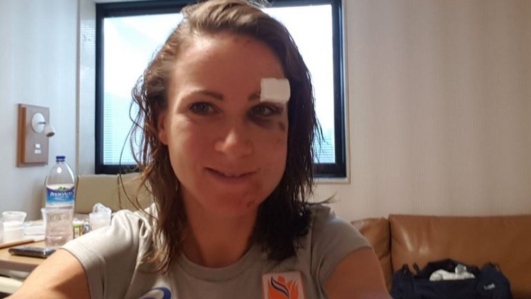 Annemiek van Vleuten reveals her facial injuries