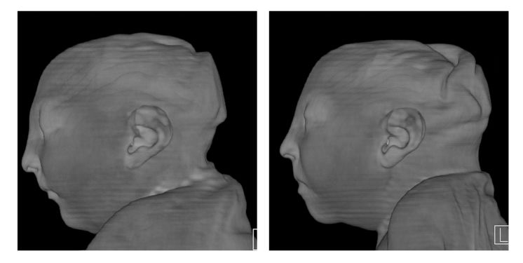 This image shows the damage to the brains of twin Brazilian girls infected with Zika during their mother’s pregnancy. The sloping forehead suggests the forebrain had not developed normally a doctor says