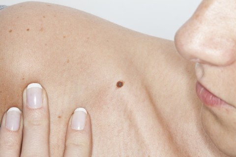 'Check your partner for cancerous moles for early detection'