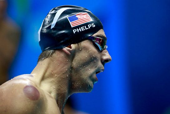 Michael Phelps's welts are a result of cupping an alternative therapy for muscle pain and numerous other ailments