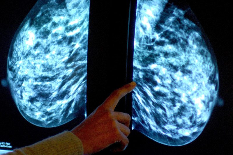 HRT is linked to higher risk of breast cancer Rui Vieira  PA Archive  Press Association Images