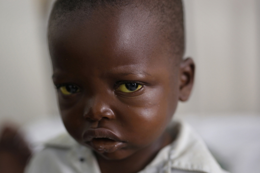 Jonathan Kangu 3 sits on his hospital bed in Kinshasa Democratic Republic of Congo after contracting symptoms of yellow fever. One of the largest yellow fever outbreaks in decades could soon spread glo