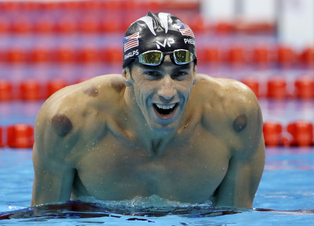 'Cupping marks are seen on the shoulders of United States&#039 Michael Phelps as he celebrates winning the gold medal in the men's 200-meter butterfly during the swimming competitions at the 2016 Summer Olympics in Rio de Janeiro Brazil. (AP