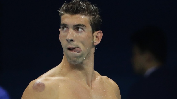 That purplish circle seen on the shoulder of U.S. swimmer Michael Phelps was caused by cupping a traditional Chinese medicine technique some athletes use to try to relieve pain