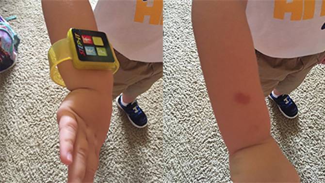 McDonald's discontinues Happy Meal “fitness” bands, due to cases of skin irritation