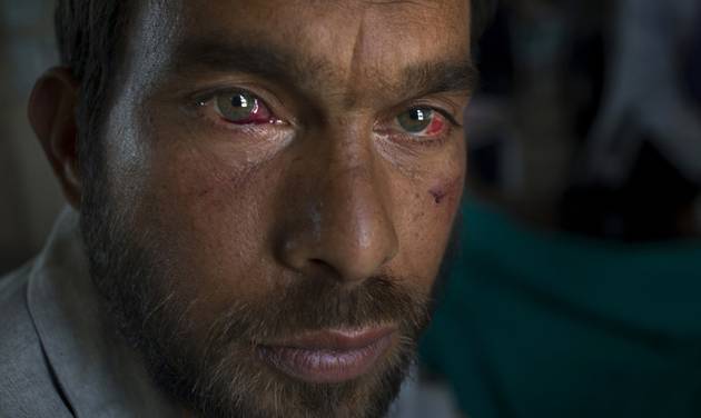 Gulzar Ahmed allegedly beaten up by Indian soldiers who picked him along with several others at Khrew village recovers at a local hospital in Srinagar Indian controlled Kashmir Thursday Aug. 18 2016. Residents of Khrew in Indian-controlled Kashmir