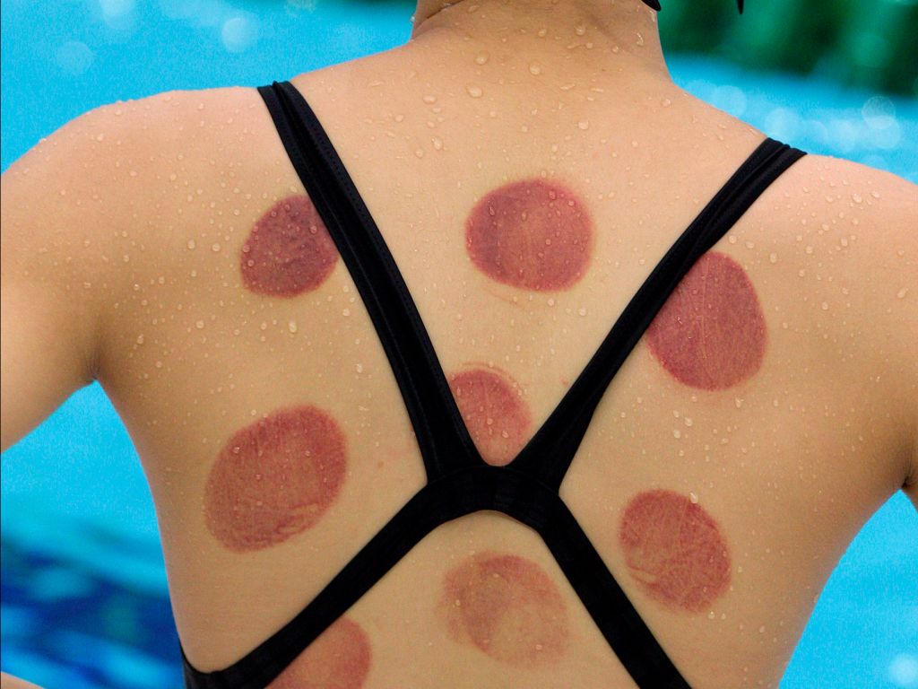 Cupping therapy