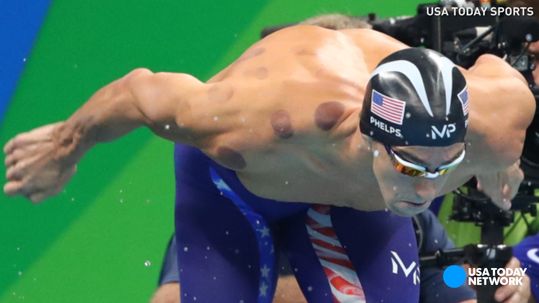 Cupping: The Eastern Practice Embraced by Michael Phelps and Hollywood Types Explained