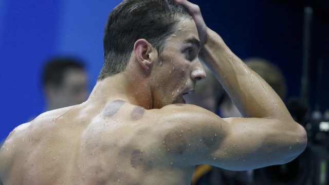 Rio 2016 Michael Phelps&#039 purple blotches spotlight 'cupping&#039 trend which cures pain