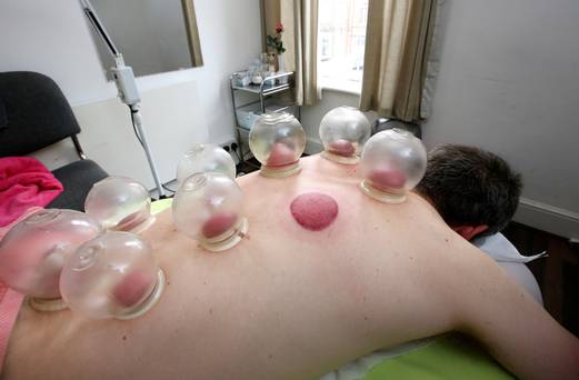 Spot on Aidan O'Doherty undergoing 'cupping&#039 at Dr Acupuncture on Dublin’s Henry Street