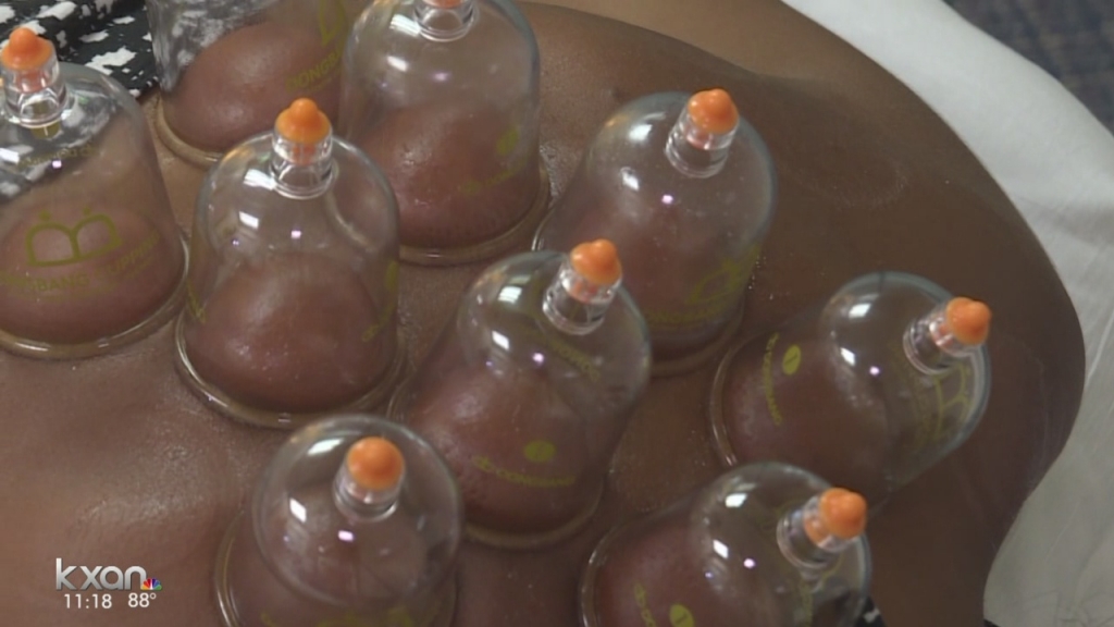 Olympic athletes go dotty for cupping