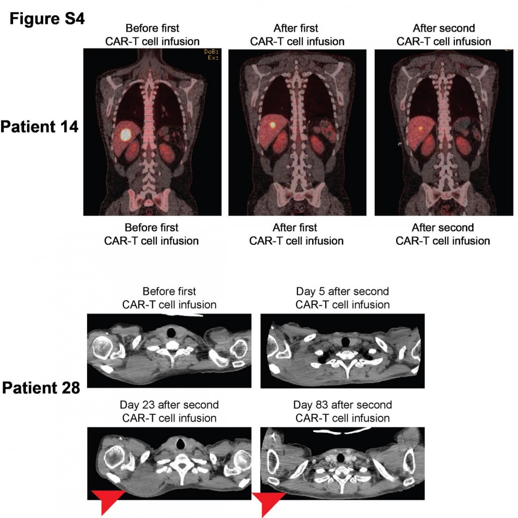 Patients with advanced lymphoma in remission after T-cell therapy