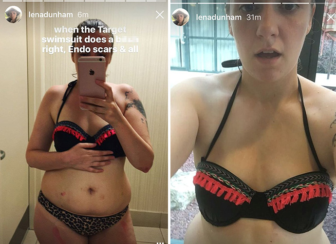 Lena Dunham proudly posts bikini selfie with 'endo scars and all'