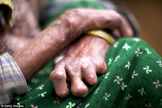 Leprosy remains a problem in tropical hot spots of the world with some 250,000 new infections reported each year. If left untreated it can cause severe nerve damage deformity and disability