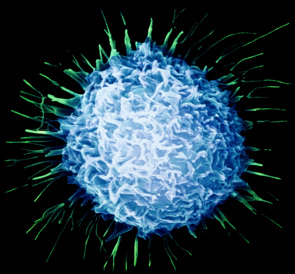 Prostate cancer cell