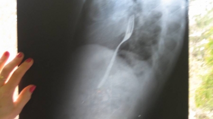 A Romanian guy swallowed a ‘fork’ in an stupid bet