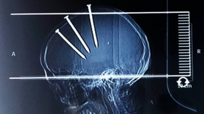 Man survived after hammering 3 four inch nails in his skull