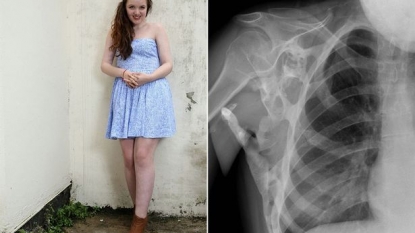 18 year old schoolgirl has ‘second’ skeleton inside her body