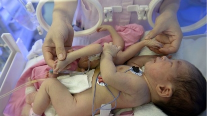 The miracle Baby born in Chinese hospital with four additional arms and legs