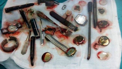 Thief swallowed six watches, a fork and many more things to avoid prison