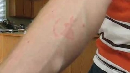 Man creates tattoo with insect bites