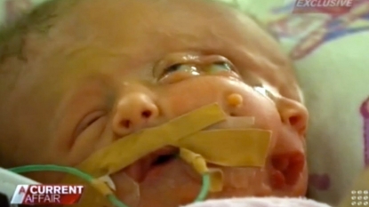 The Miracle new born twins have two brains in same skull