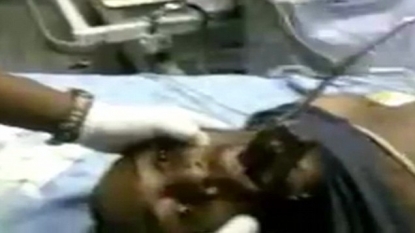 Doctors removed the stuck mobile phone from a man’s mouth