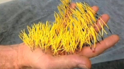 Man ended up with 400 porcupine quills in his hand after his try of hitting it