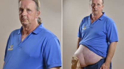 Patient’s hernia grown to size of football after the hospital made a mistake