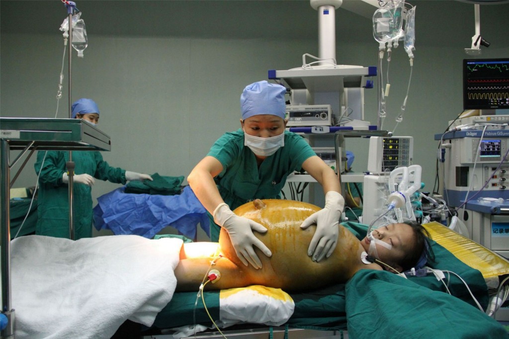 15 kg of tumor was removed from the belly of twelve year old school girl