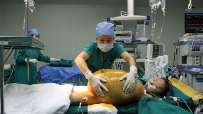 15 kg of tumor was removed from the belly of twelve year old school girl