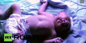 Doctors are battling to save the kid born with two faces but one body