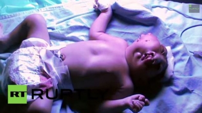 Doctors are battling to save the kid born with two faces but one body