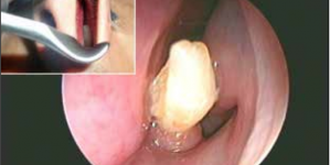 Doctors removed the growing tooth from inside the nasal cavity of a man