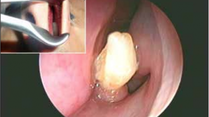 Doctors removed the growing tooth from inside the nasal cavity of a man