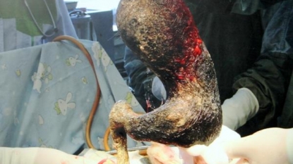 Doctors removed the massive hairball from the stomach of 18 year old girl