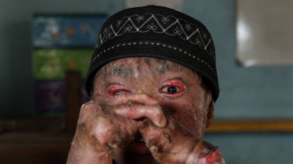 Meet a kid who sheds his body skin in every 45 hours