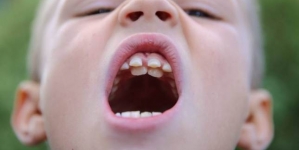 A kid is developing an extra set of natural teeth – named as ‘Jaws’ by friends