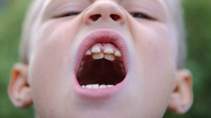 A kid is developing an extra set of natural teeth – named as ‘Jaws’ by friends