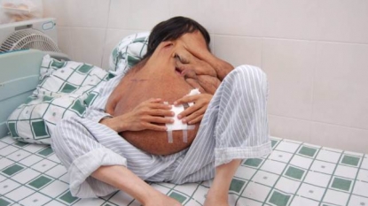 Doctors removed the world’s largest facial tumor from a Chinese man