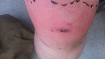 Man is suing the hospital for failing to remove the teeth from his knee