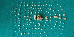 Girl has more than 200 teeth inside her mouth – led to severe pain