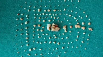 Girl has more than 200 teeth inside her mouth – led to severe pain